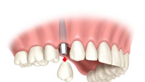 Одномоментная имплантация зуба и ее основные преимущества